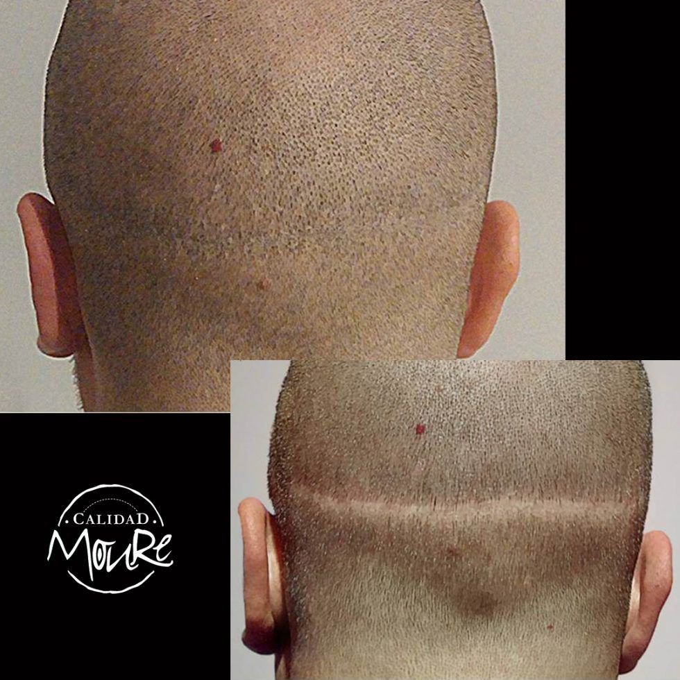 Micropigmentación Capilar Mallorca. Calvicie. Galería. OFERTA DE MICROPIGMENTACIÓN CAPILAR POR SOLO 290€ Una sesión de dos horas de Micropigmentación Capilar. Técnica pelo a pelo o punteado.