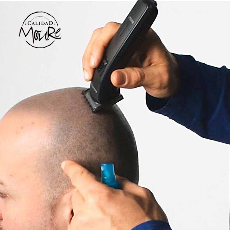 Micropigmentación Capilar Mallorca. Calvicie. Galería. OFERTA DE MICROPIGMENTACIÓN CAPILAR POR SOLO 290€ Una sesión de dos horas de Micropigmentación Capilar. Técnica pelo a pelo o punteado.