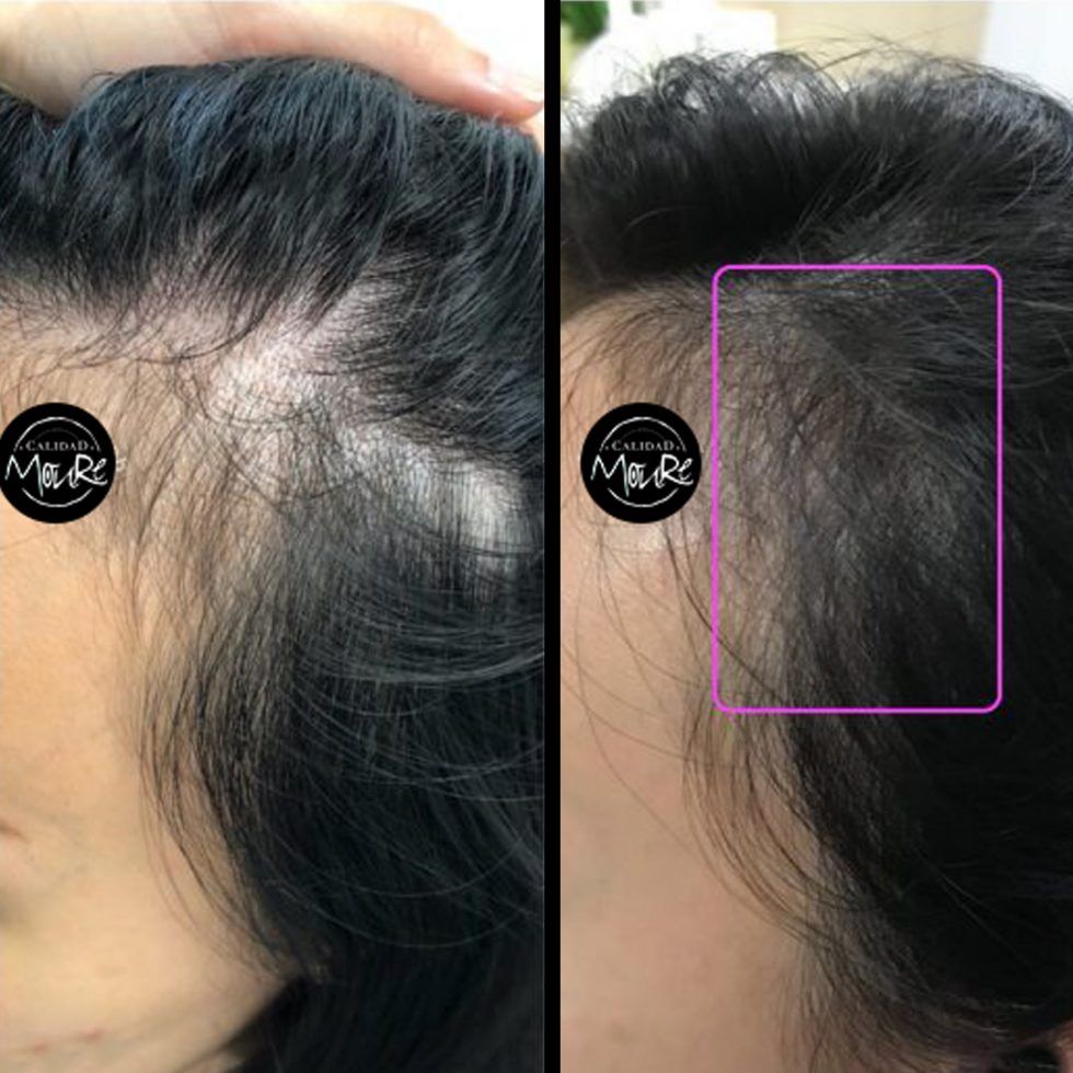 Micropigmentación Mallorca. Centros Moure. OFERTA DE MICROPIGMENTACIÓN CAPILAR 290€. 1 sesión de 2 horas. Técnica pelo a pelo o punteado.