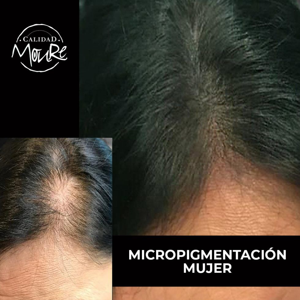 Micropigmentación Mallorca. Centros Moure. OFERTA DE MICROPIGMENTACIÓN CAPILAR 290€. 1 sesión de 2 horas. Técnica pelo a pelo o punteado.