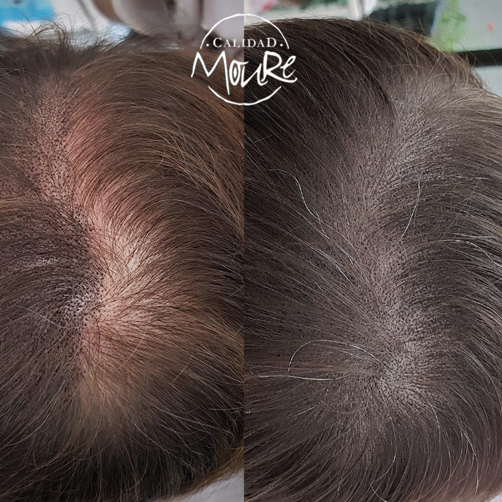 Micropigmentación Capilar Mallorca. Calvicie relleno pelo largo. OFERTA DE MICROPIGMENTACIÓN CAPILAR POR SOLO 290€ Una sesión de dos horas de Micropigmentación Capilar. Técnica pelo a pelo o punteado.