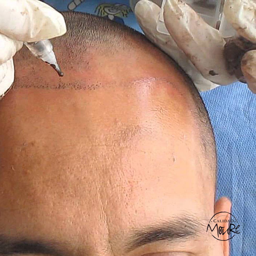 Micropigmentación Capilar Mallorca. OFERTA DE MICROPIGMENTACIÓN CAPILAR POR SOLO 290€ Una sesión de dos horas de Micropigmentación Capilar. Técnica pelo a pelo o punteado.