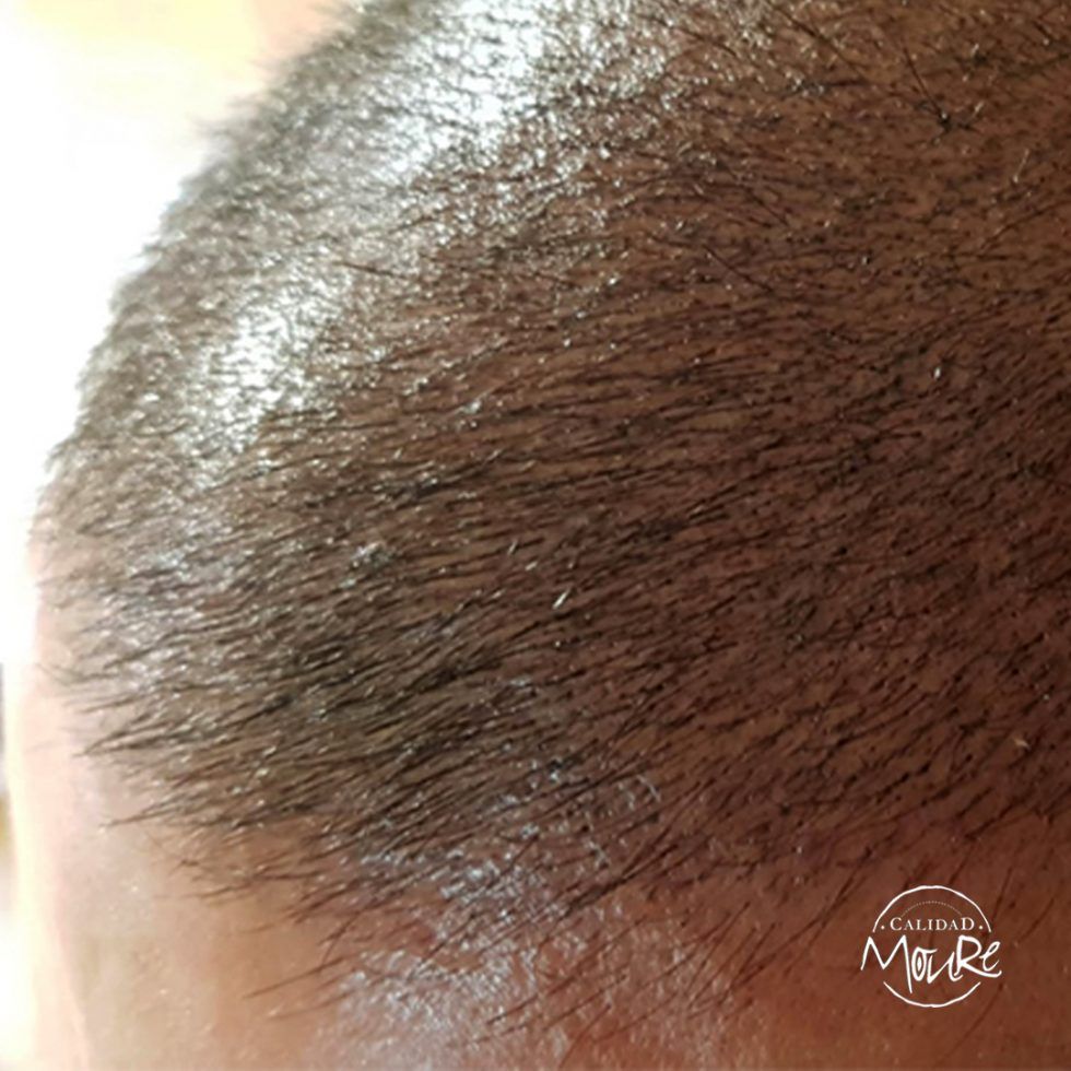 Pasos de la Micropigmentación Capilar Mallorca. OFERTA DE MICROPIGMENTACIÓN CAPILAR POR SOLO 290€ Una sesión de dos horas de Micropigmentación Capilar. Técnica pelo a pelo o punteado.