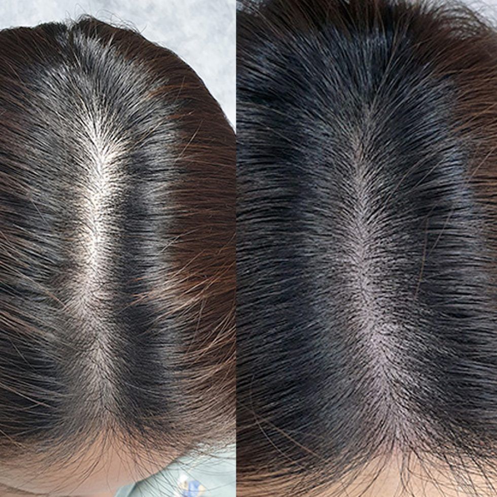 Pasos de la Micropigmentación Capilar Mallorca. OFERTA DE MICROPIGMENTACIÓN CAPILAR POR SOLO 290€ Una sesión de dos horas de Micropigmentación Capilar. Técnica pelo a pelo o punteado.