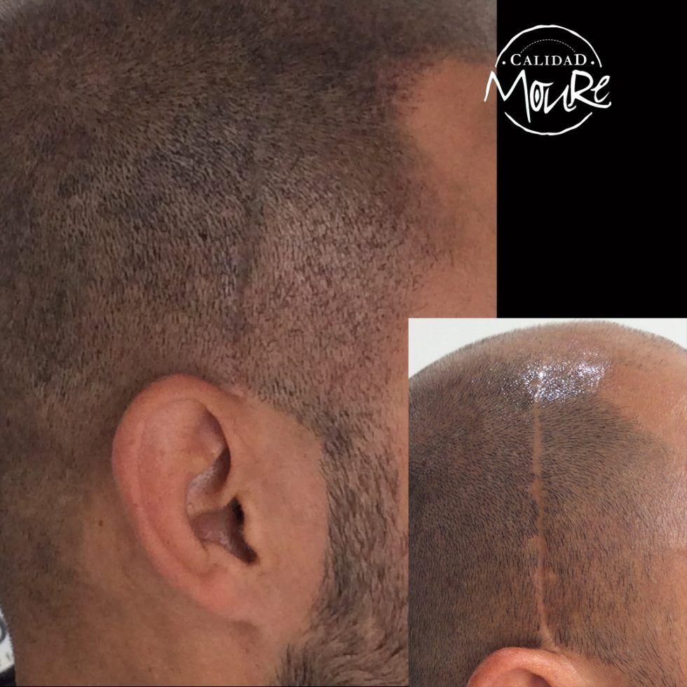 Pasos de la Micropigmentación Capilar Mallorca. OFERTA DE MICROPIGMENTACIÓN CAPILAR POR SOLO 290€ Una sesión de dos horas de Micropigmentación Capilar. Técnica pelo a pelo o punteado.