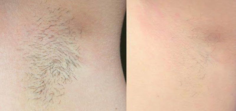 FOTODEPILACION LASER MOURE MUJER IPL LIGHT (8)