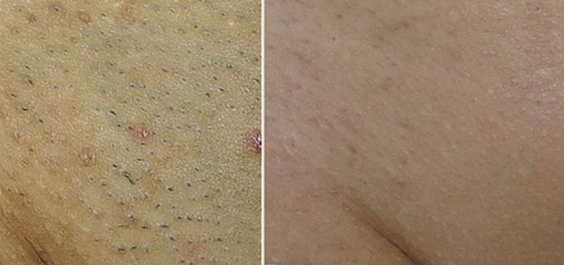 DEPILACION LASER HOMBRE CENTROS MOURE MALLORCA