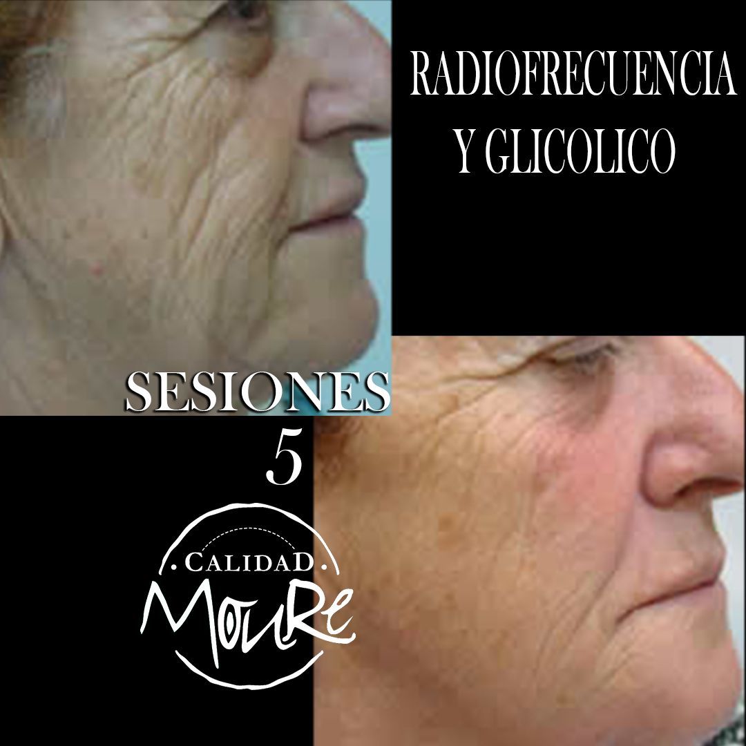 RADIOFRECUENCIA LASER GALVANICA Y ACIDO HIALURONICO CENTRO DE ESTETICA MOURE MALLORCA (11)