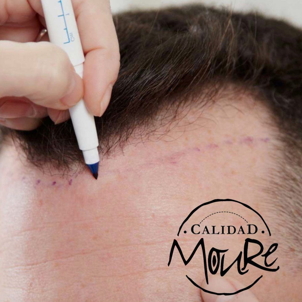 Micropigmentación Mallorca. Centros Moure. OFERTA DE MICROPIGMENTACIÓN CAPILAR 290€. 1 sesión de 2 horas. Técnica pelo a pelo o punteado.