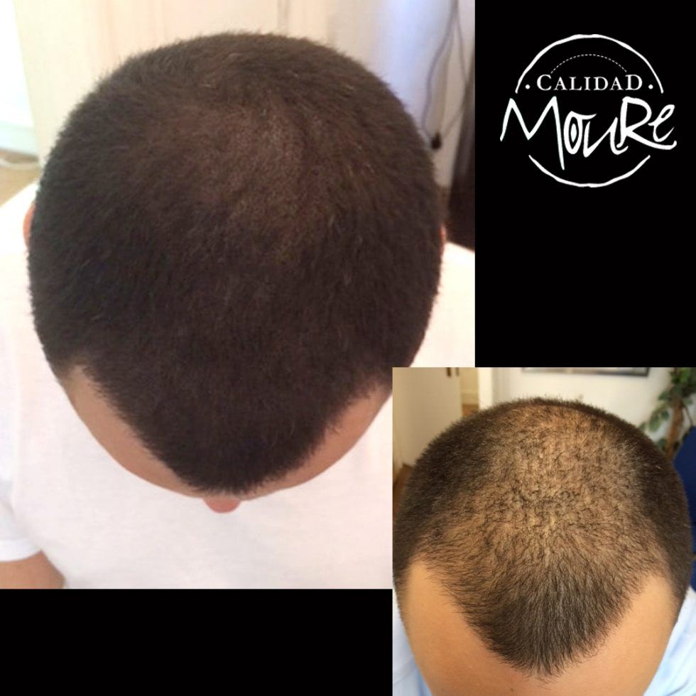 Micropigmentación Mallorca. Centros Moure. OFERTA DE MICROPIGMENTACIÓN CAPILAR 290€. 1 sesión de 2 horas. Técnica pelo a pelo o punteado.
