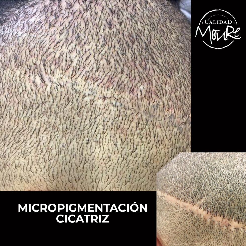 Micropigmentación Mallorca. Centros Moure. OFERTA DE MICROPIGMENTACIÓN CAPILAR 290€. 1 sesión de 2 horas. Técnica pelo a pelo o punteado.