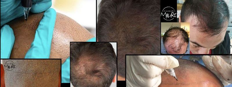 Micropigmentación Capilar Mallorca Calvicie.OFERTA DE MICROPIGMENTACIÓN CAPILAR POR SOLO 290€ Una sesión de dos horas de Micropigmentación Capilar. Técnica pelo a pelo o punteado.