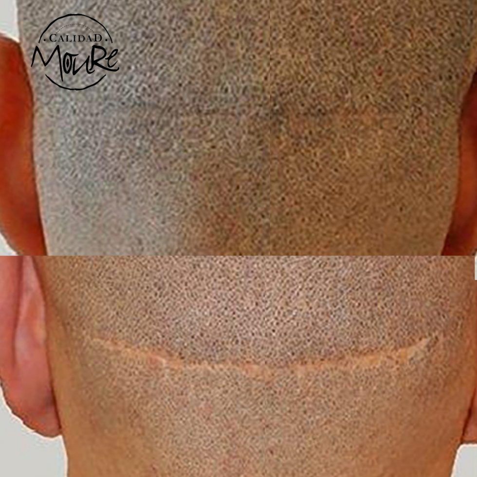 Micropigmentación Capilar Mallorca. Cicatrices. OFERTA DE MICROPIGMENTACIÓN CAPILAR POR SOLO 290€ Una sesión de dos horas de Micropigmentación Capilar. Técnica pelo a pelo o punteado.