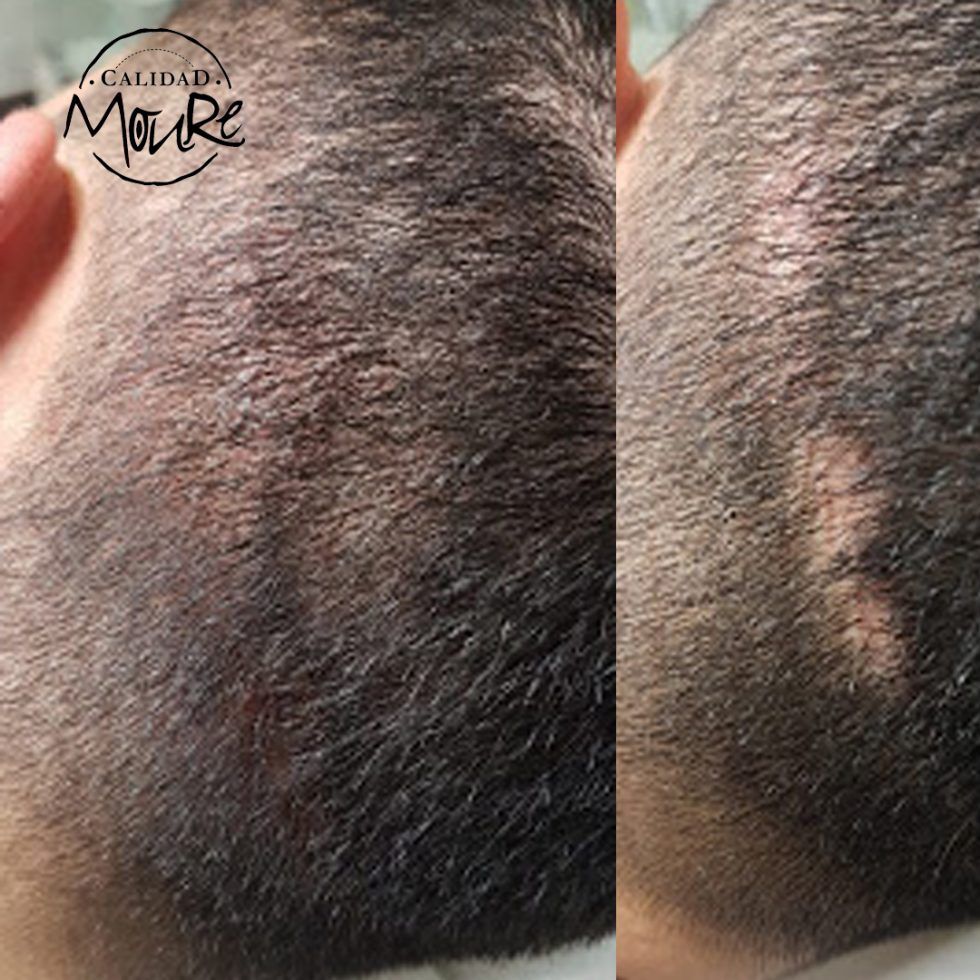 Micropigmentación Capilar Mallorca. Cicatrices. OFERTA DE MICROPIGMENTACIÓN CAPILAR POR SOLO 290€ Una sesión de dos horas de Micropigmentación Capilar. Técnica pelo a pelo o punteado.