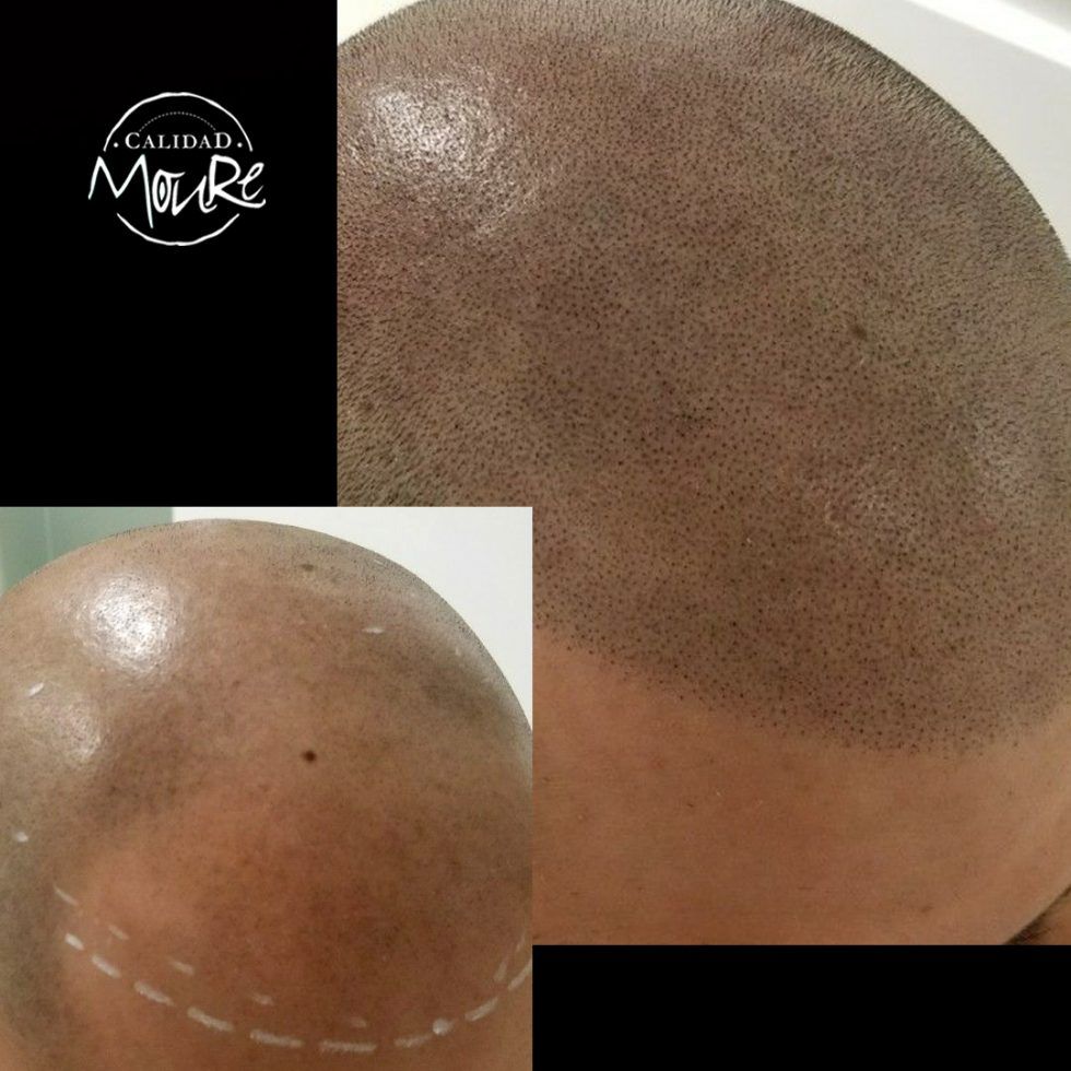 Micropigmentación Capilar Mallorca. Técnica Detalle Rasurado. OFERTA DE MICROPIGMENTACIÓN CAPILAR POR SOLO 290€ Una sesión de dos horas de Micropigmentación Capilar. Técnica pelo a pelo o punteado.