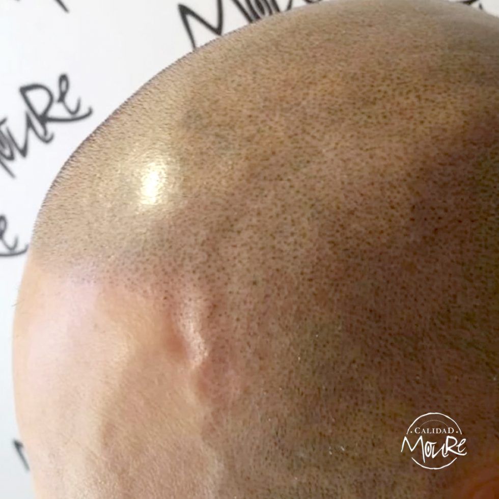 Micropigmentación Capilar Mallorca. Técnica Detalle Rasurado. OFERTA DE MICROPIGMENTACIÓN CAPILAR POR SOLO 290€ Una sesión de dos horas de Micropigmentación Capilar. Técnica pelo a pelo o punteado.