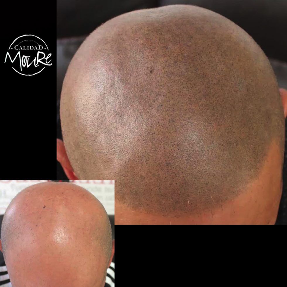 Micropigmentación Capilar Mallorca. Técnica Detalle Rasurado. OFERTA DE MICROPIGMENTACIÓN CAPILAR POR SOLO 290€ Una sesión de dos horas de Micropigmentación Capilar. Técnica pelo a pelo o punteado.
