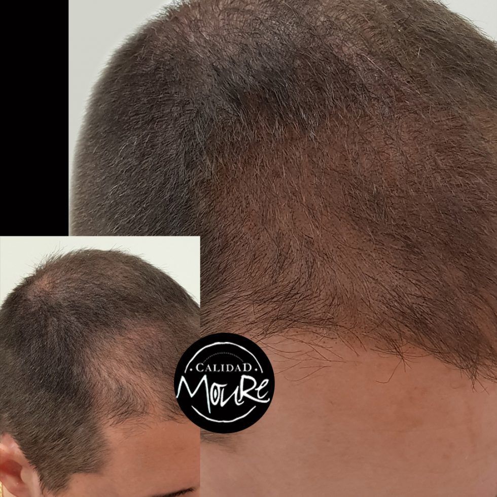 Micropigmentación Capilar Mallorca. Cicatrices. OFERTA DE MICROPIGMENTACIÓN CAPILAR POR SOLO 290€ Una sesión de dos horas de Micropigmentación Capilar. Técnica pelo a pelo o punteado.