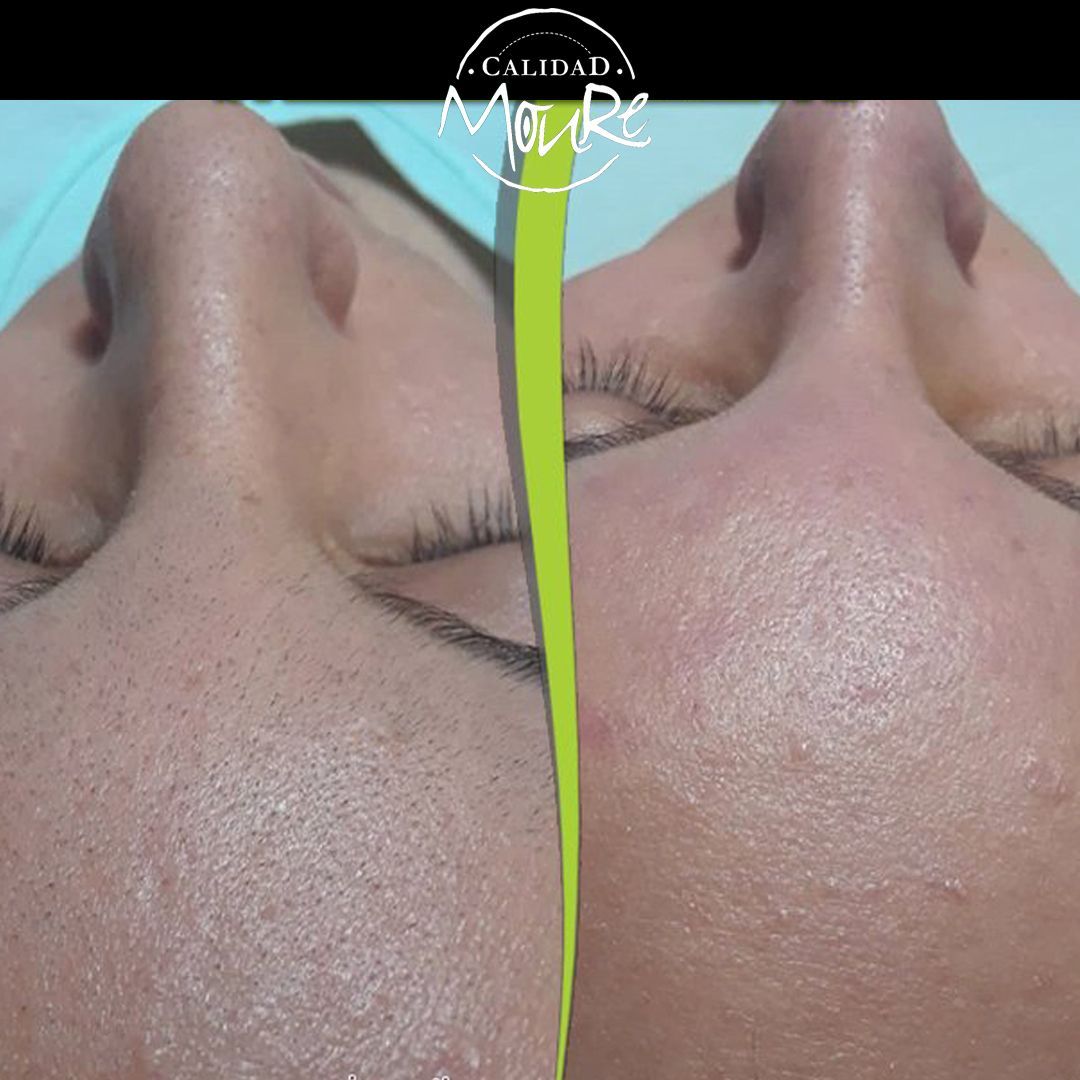 ANTES Y DESPUES DE LIMPIEZA POR ULTRASONIDOS PUNTOS NEGROS E IMPUREZAS (1)