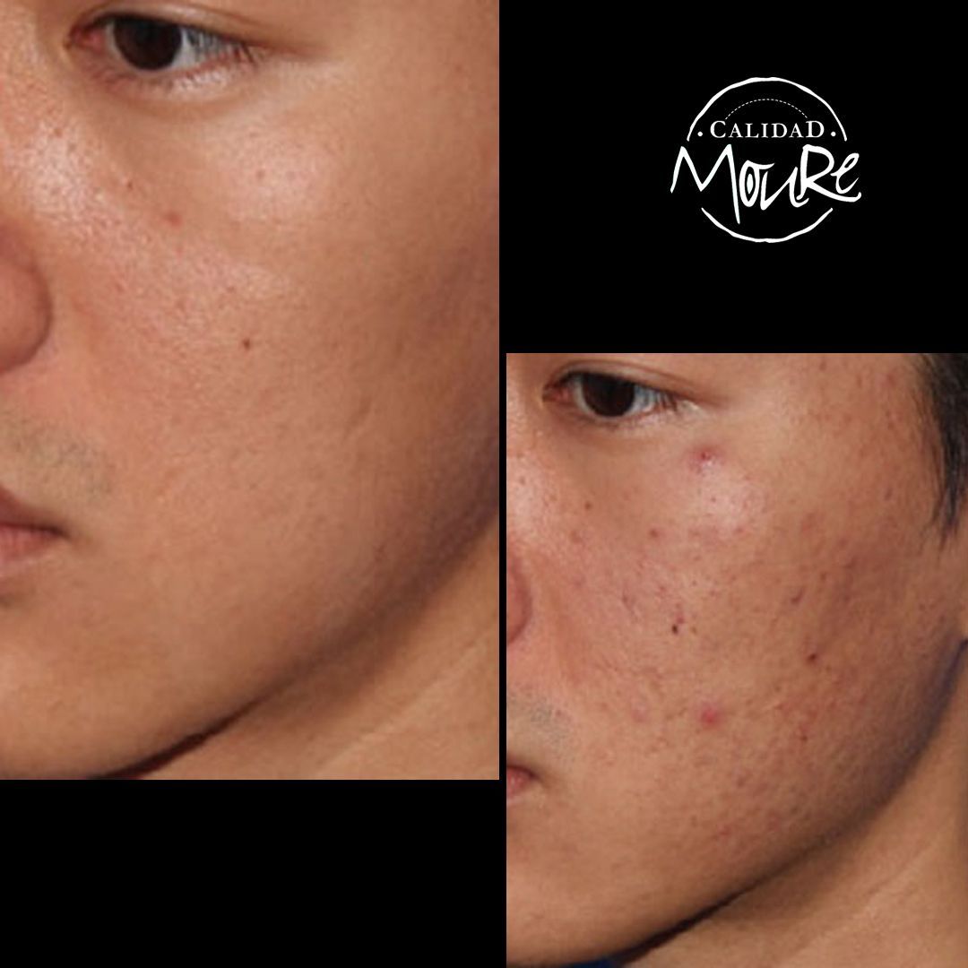 ANTES Y DESPUES DE LIMPIEZA POR ULTRASONIDOS PUNTOS NEGROS E IMPUREZAS (3)