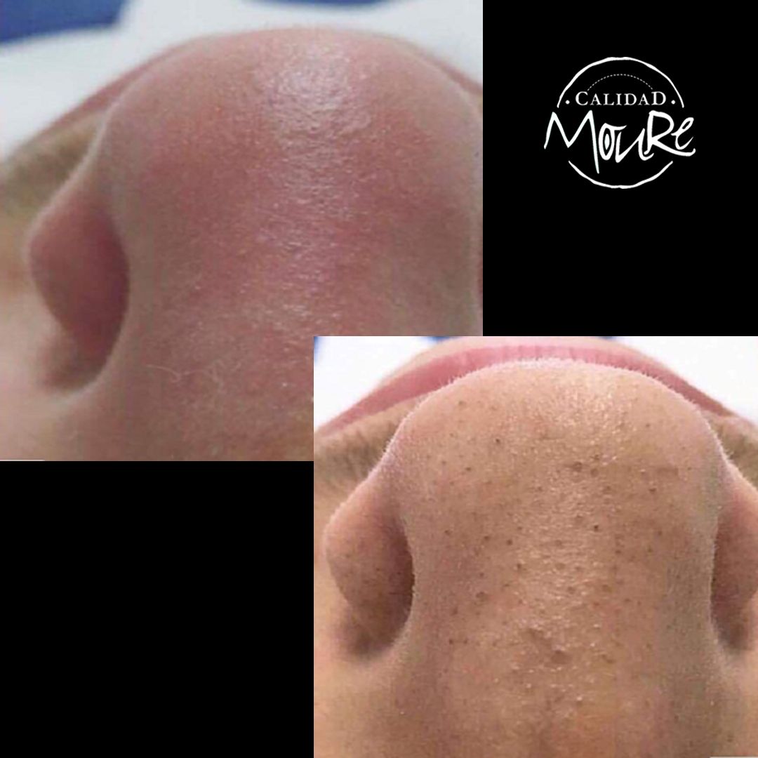 ANTES Y DESPUES DE LIMPIEZA POR ULTRASONIDOS PUNTOS NEGROS E IMPUREZAS (5)