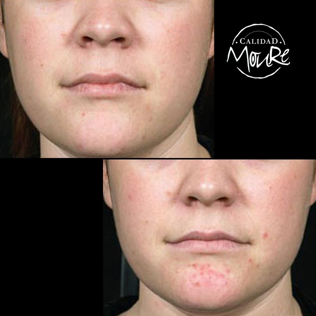 ANTES Y DESPUES DE LIMPIEZA POR ULTRASONIDOS PUNTOS NEGROS E IMPUREZAS (6)