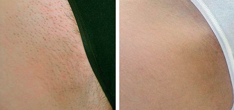 FOTODEPILACION LASER MOURE MUJER IPL LIGHT (2)