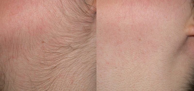 FOTODEPILACION LASER MOURE MUJER IPL LIGHT (3)