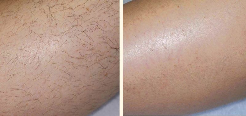 FOTODEPILACION LASER MOURE MUJER IPL LIGHT (5)