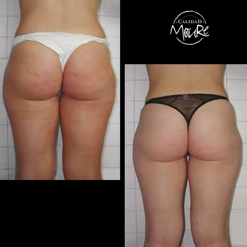 FOTOS DE ANTES Y DESPUES DE TRATAMIENTO DE REAFIRMACION DE GLUTEOS (4)
