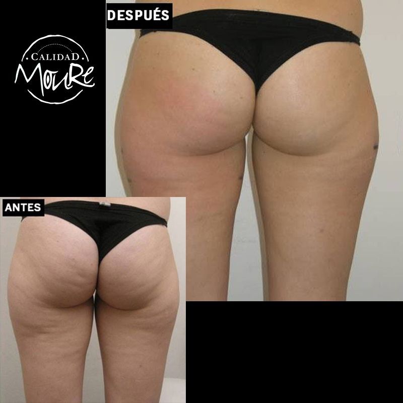 FOTOS DE ANTES Y DESPUES DE TRATAMIENTO DE REAFIRMACION DE GLUTEOS (6)