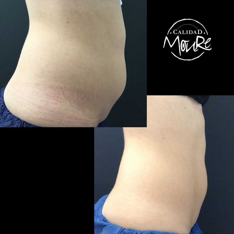 FOTOS DE RESULTADOS ANTES Y DESPUES DE TRATAMIENTO REDUCTOR CORPORAL MOURE MALLORCA (2)