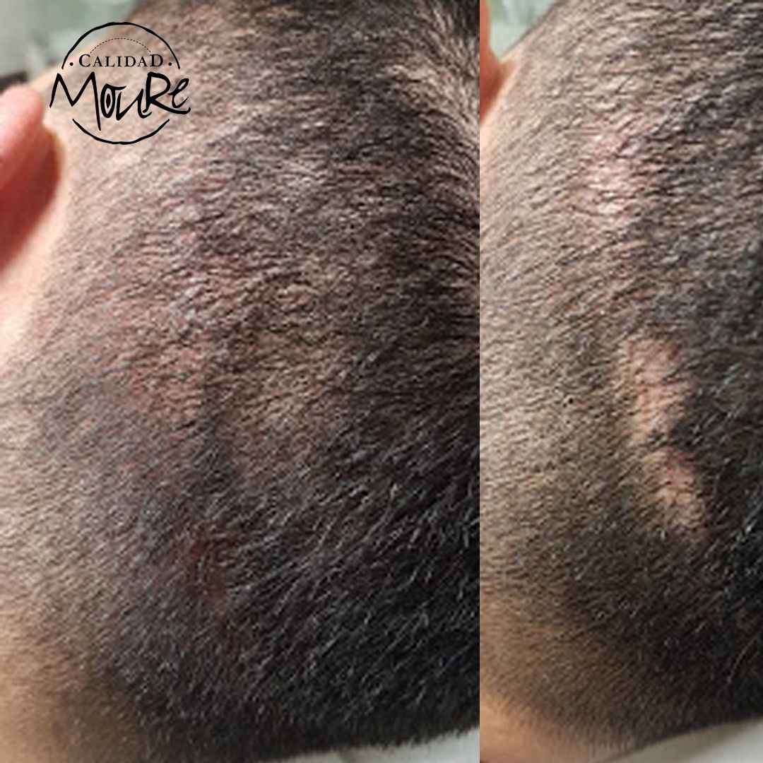 MICROPIGMENTACION CAPILAR CICATRICES MOURE (3)