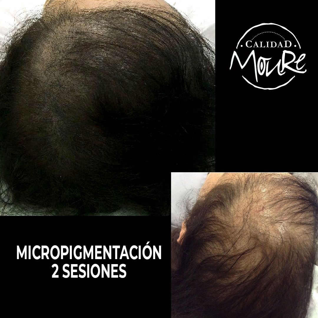 MICROPIGMENTACION MUJER MOURE MAS DENSIDAD PELO LARGO (15)