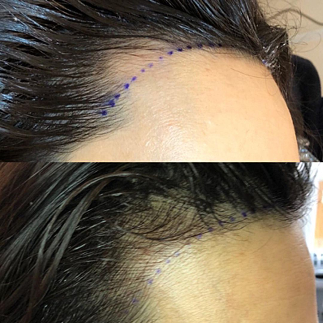 MICROPIGMENTACION MUJER MOURE MAS DENSIDAD PELO LARGO (16)