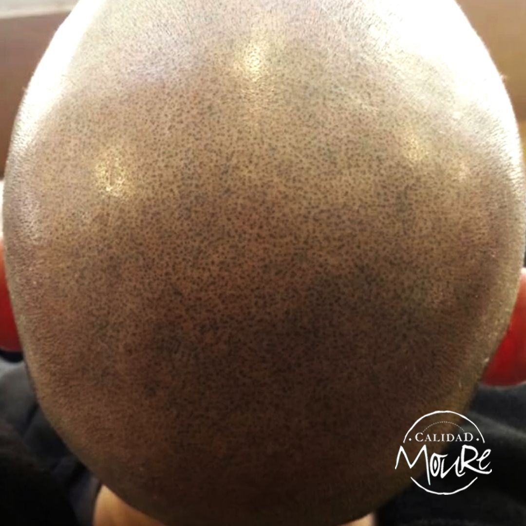 MICROPIGMENTACION RASURADO MOURE MALLORCA (11)