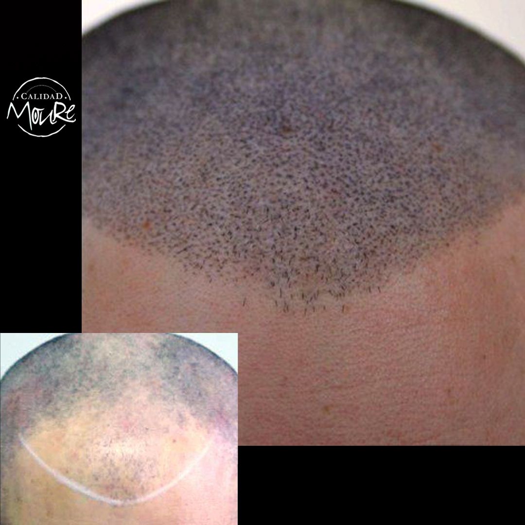 MICROPIGMENTACION RASURADO MOURE MALLORCA (18)