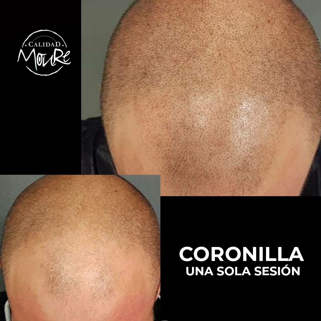 MICROPIGMENTACION RASURADO MOURE MALLORCA (5)