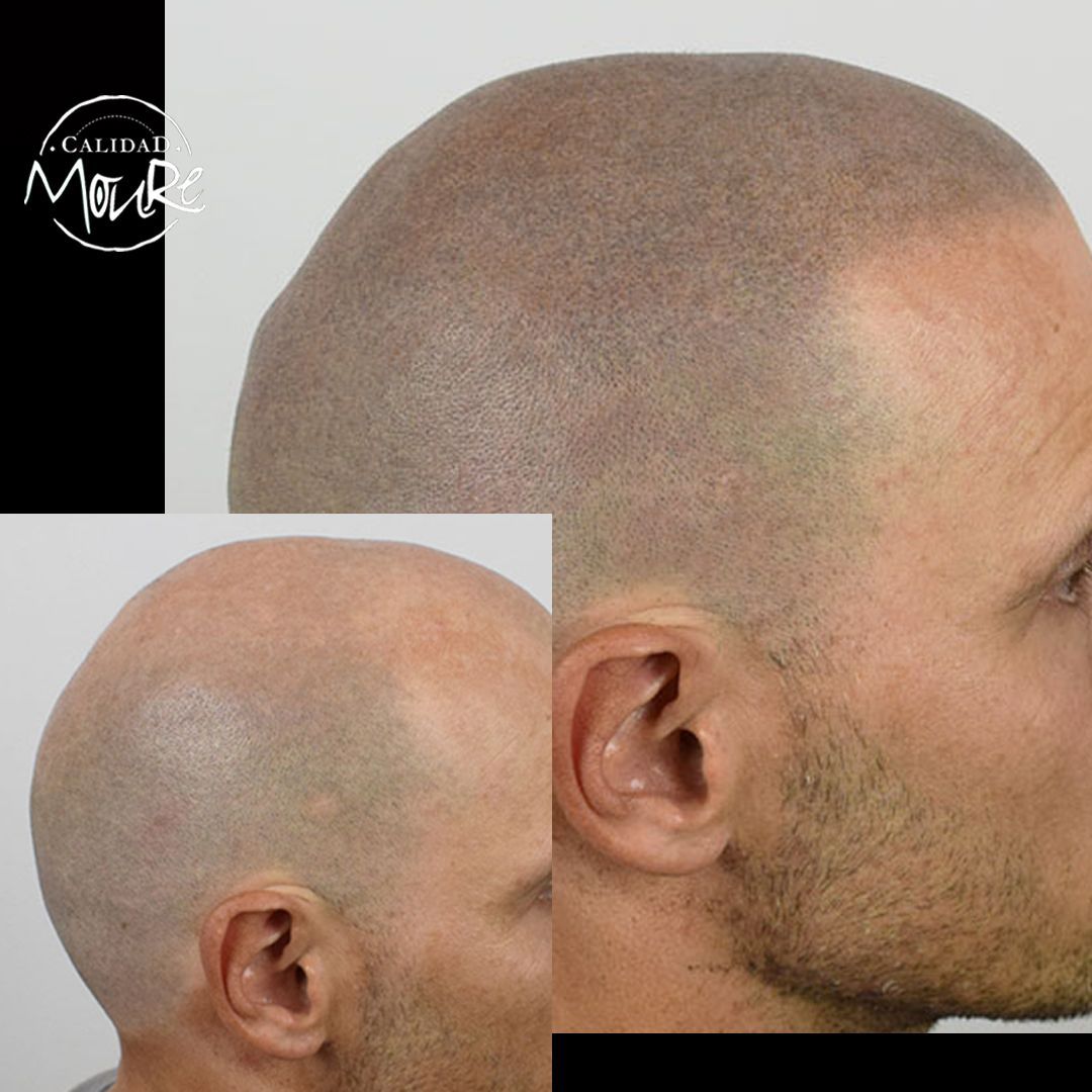 MICROPIGMENTACION RASURADO MOURE MALLORCA (9)