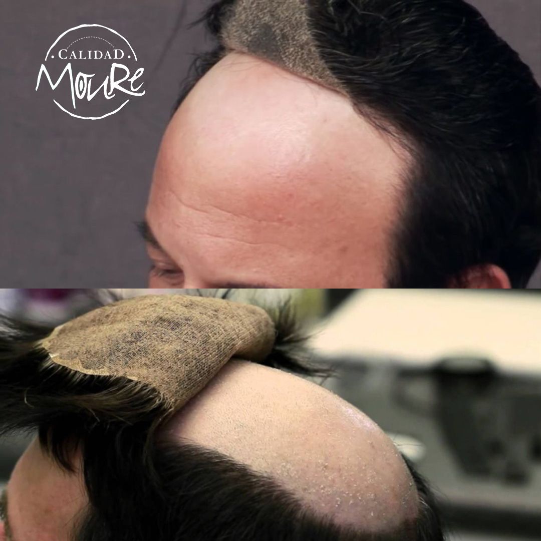 PROTESIS CABALLERO MOURE MALLA SUIZA (7)