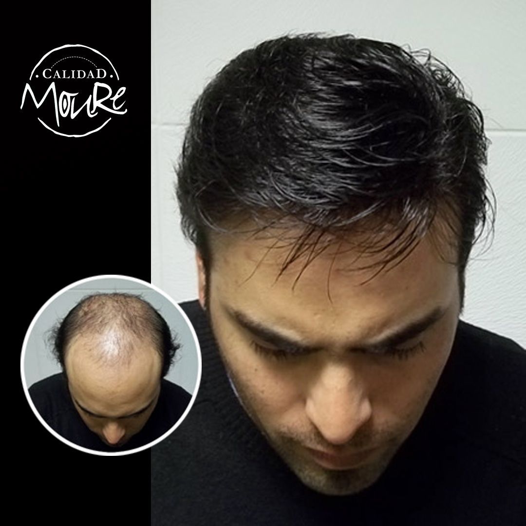 PROTESIS CABALLERO MOURE MALLA SUIZA (8)