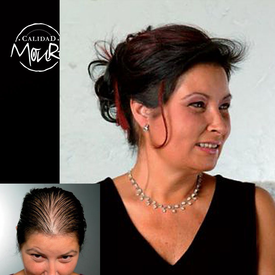 PROTESIS MALLA SUIZA MUJER MOURE (2)