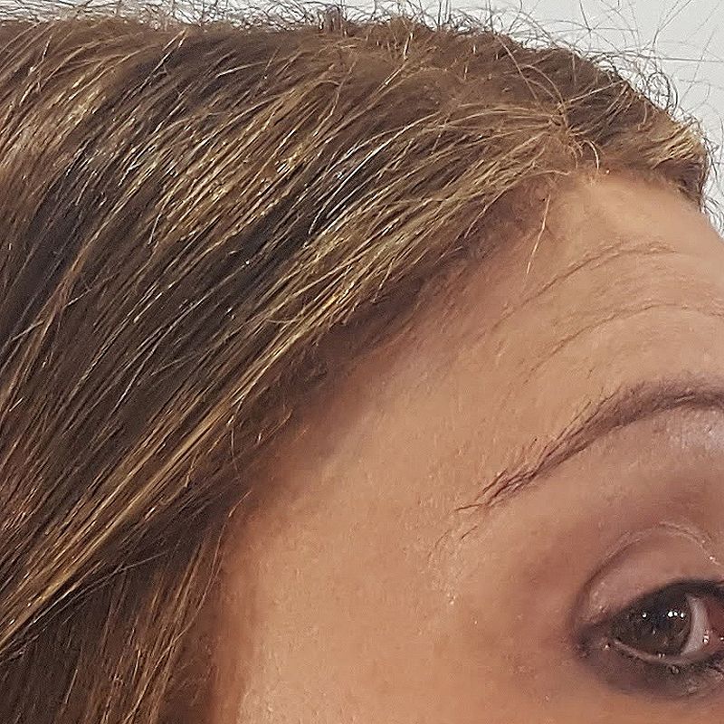 PROTESIS MUJER MOURE (11)