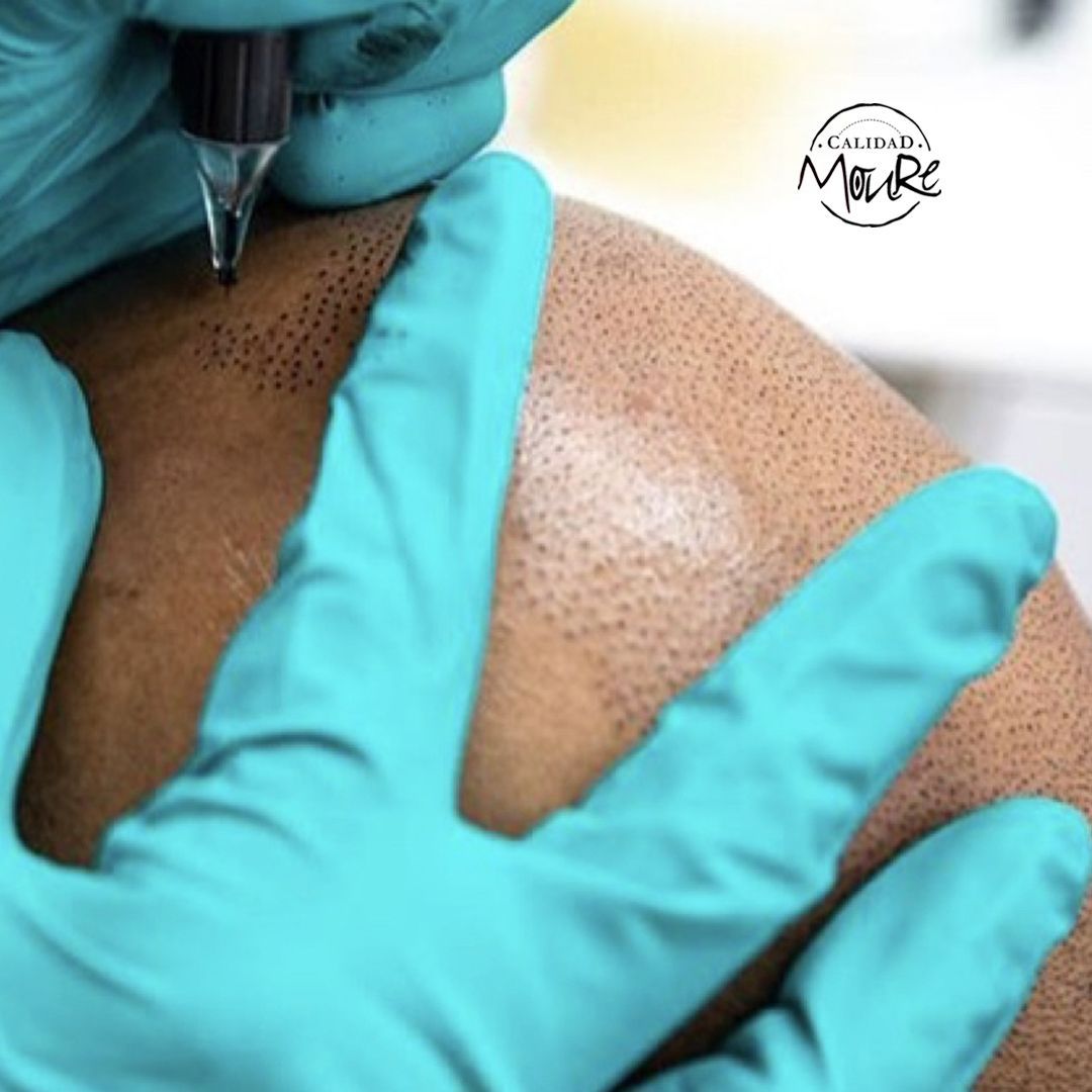 TECNICA DE REALIZACION DE MICROPIGMENTACION CAPILAR (3)