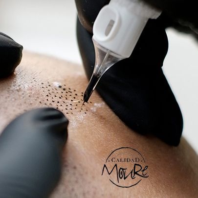 TECNICA DE REALIZACION DE MICROPIGMENTACION CAPILAR (7)