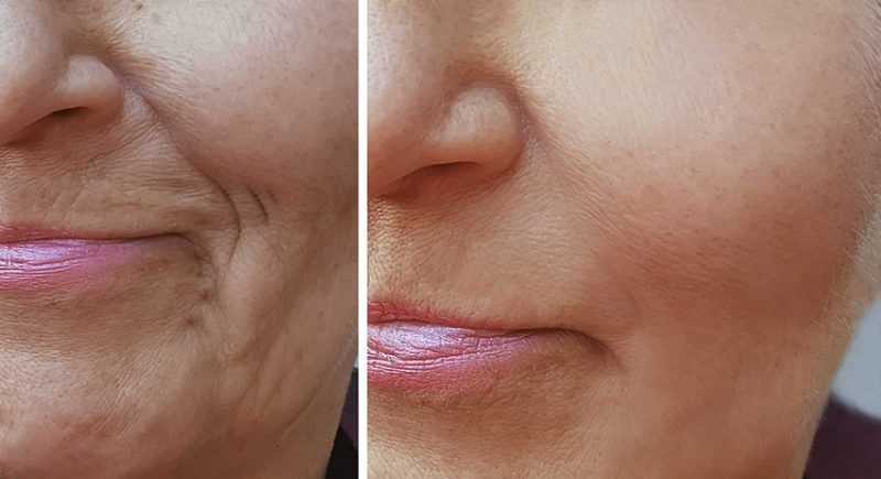 Antes y despues de hialuronico radiofreciencia, acidos y mesoterapia (1)