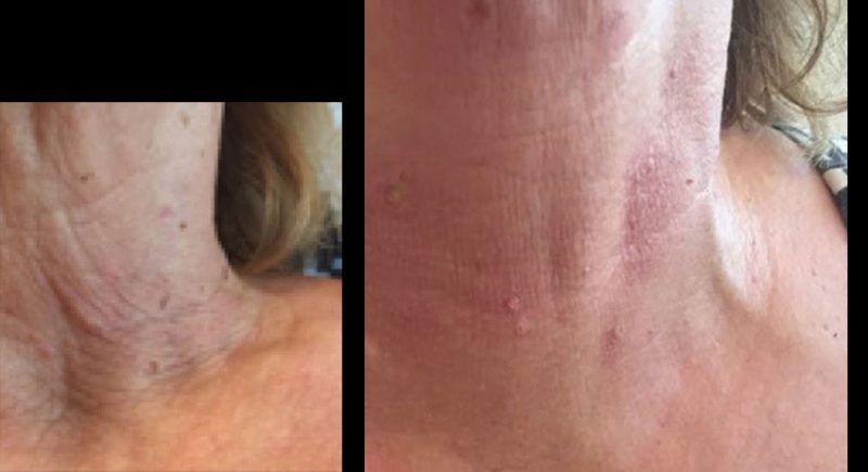 Antes y despues de hialuronico radiofreciencia, acidos y mesoterapia (4)