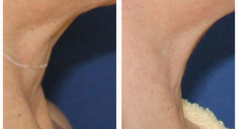 Antes y despues de hialuronico radiofreciencia, acidos y mesoterapia (5)