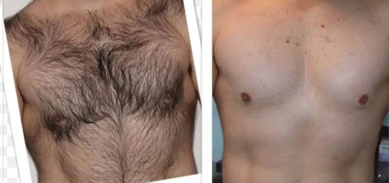 DEPILACION LASER HOMBRE CENTROS MOURE (4) MALLORCA