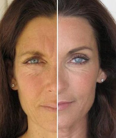 Fotorejuvenecimiento y acido hialuronico (5)